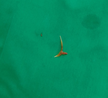 Tin tức đời sống ngày 21/8: Mảnh xương cá mắc kẹt trong cổ người phụ nữ suốt 1 tháng