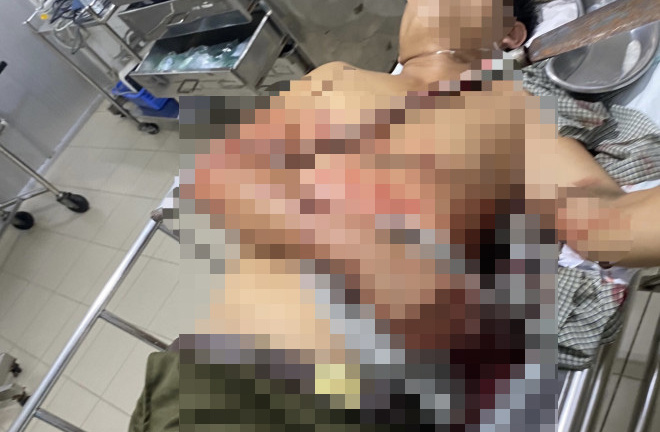 Tổ trưởng dân phòng bị đâm xuyên cánh tay khi ngăn chặn hỗn chiến