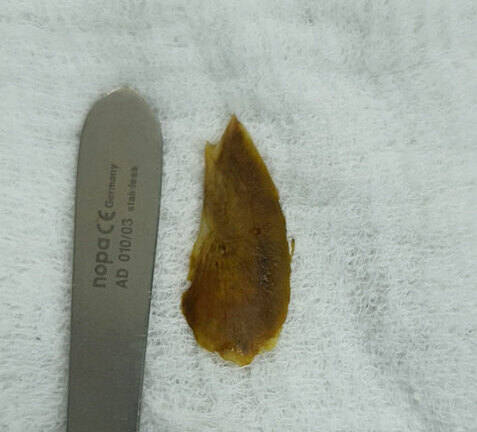 Thủng ruột non do vô tình nuốt phải mang xương cá