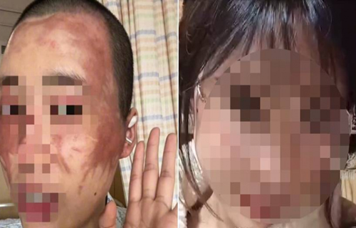 Vợ bị chồng tạt axit vì lý do khó tin