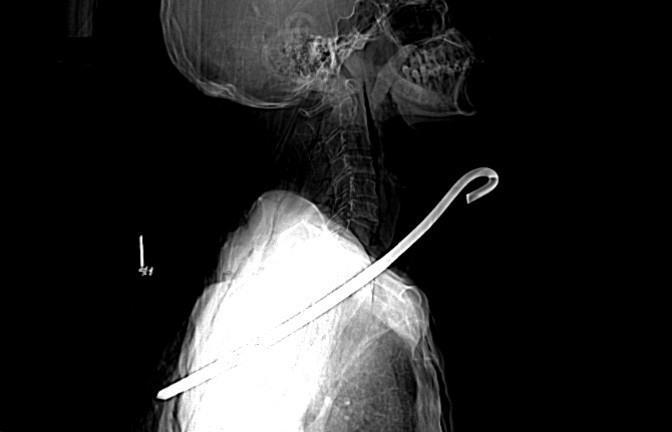 Vấp ngã trong lúc chăn bò, người đàn ông bị thanh sắt dài 30cm đâm xuyên cổ