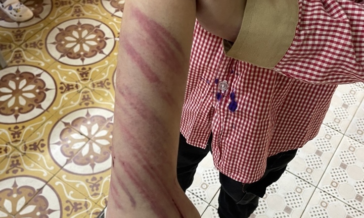 Vụ học sinh lớp 2 nghi bị bạn trai của mẹ bạo hành: Nhà trường thông tin