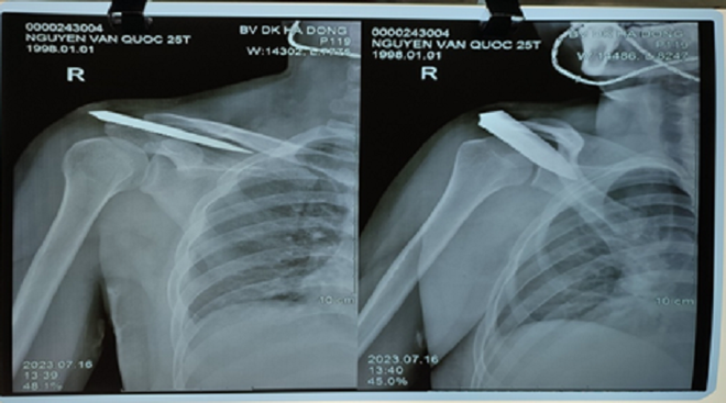 Cứu sống nam thanh niên bị dao đâm