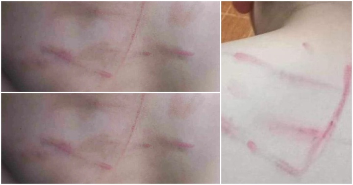 Tin tức mới nhất vụ học sinh lớp 4 bị cô giáo dùng roi tre đánh tím lưng