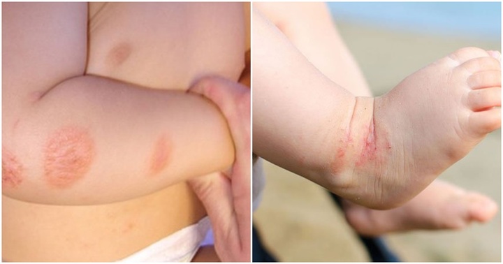1001 câu hỏi của người lần đầu làm mẹ: Con bị côn trùng cắn, mẹ