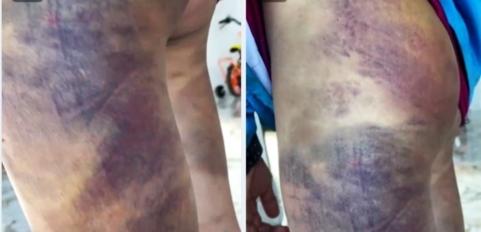 Vụ nam sinh lớp 6 ở Lâm Đồng bị bạn hành hung bầm tím khắp cơ thể: Hé lộ nguyên nhân