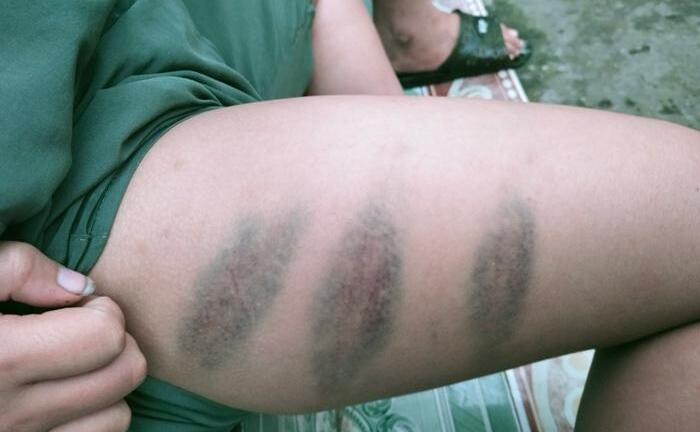 Vụ người mẹ trẻ ở Phú Thọ tố chồng cũ đánh con bầm tím thân thể: Người chồng nói gì?