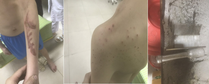 Tra tấn nhân viên như thời trung cổ, nữ chủ quán bánh xèo lĩnh 30 tháng tù