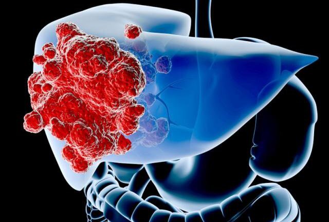 Ung thư gan và điều cần biết