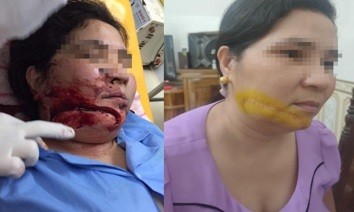 Hàm Yên, Tuyên Quang: Cần làm rõ hành vi kẻ chém người phụ nữ gây thương tích nghiêm trọng, nhưng vẫn nhởn nhơ ngoài vòng pháp luật