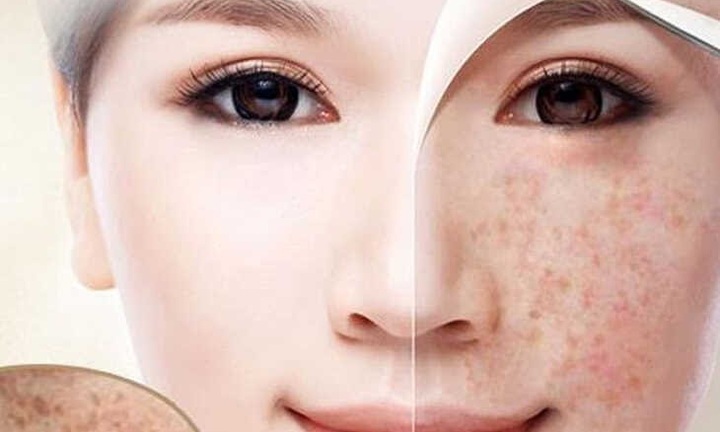 Nám nội tiết: Nguyên nhân và cách loại bỏ