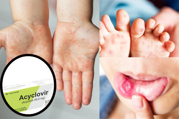Bệnh tay chân miệng gia tăng, chuyên gia cảnh báo tình trạng phụ huynh dùng sai thuốc điều trị