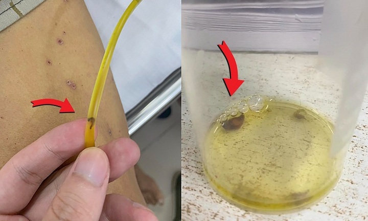 Hy hữu: Sán lá Gan lổm ngổm chui ra từ ống mật của người đàn ông 57 tuổi