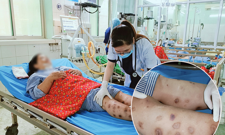 Từ vụ hoại tử khi mua canxi về nhà tiêm: Bác sĩ chỉ ra những sai lầm nhiều người mắc phải