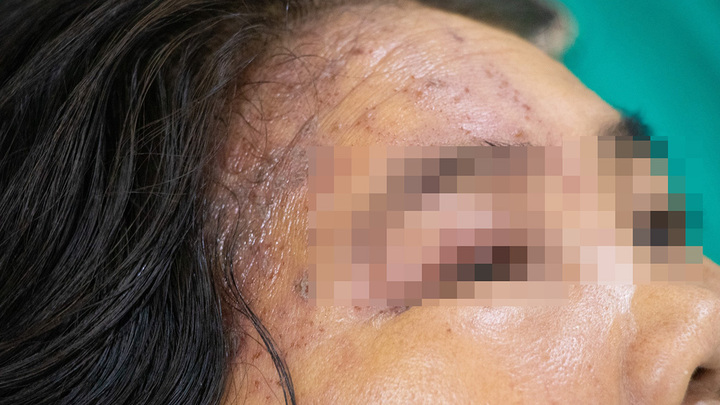 Người phụ nữ 60 tuổi nhập viện gấp vì biến chứng Zona sau khi tự chữa ở nhà