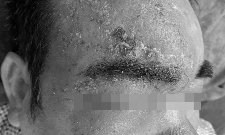 Nghĩ bị giời leo, người đàn ông tự ý đắp lá tại nhà khiến mắt suýt mù