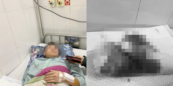 Ký ức kinh hoàng về bữa lẩu sát Tết khiến nam sinh mất đi bàn tay nguyên vẹn