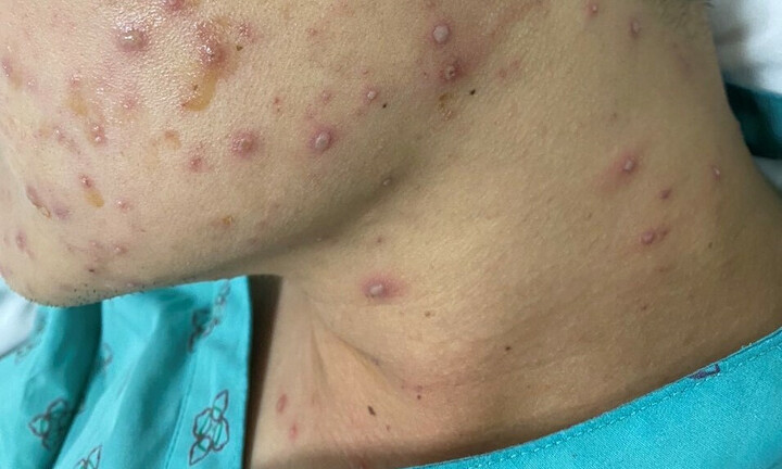 Bệnh thủy đậu có xu hướng gia tăng do thời tiết giao mùa, chuyên gia lưu ý điều quan trọng