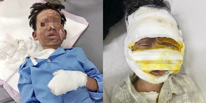 Bắc Giang: Máy tính phát nổ, nam sinh lớp 2 bị bỏng nặng toàn thân