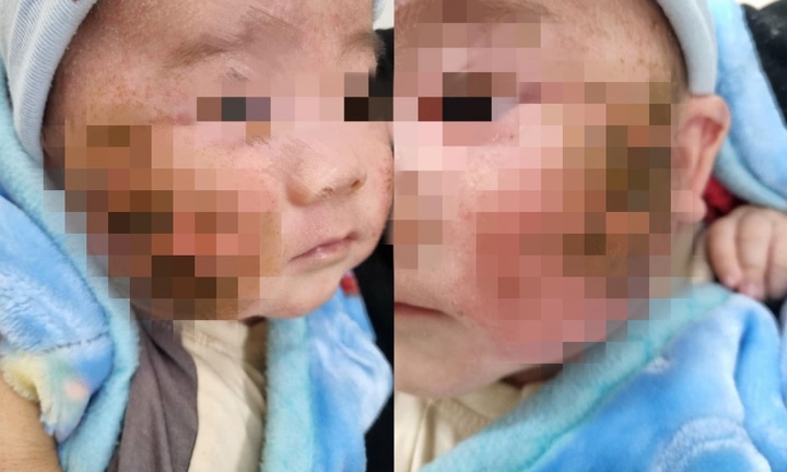 Trẻ sơ sinh loét má chảy dịch do sai lầm nhiều cha mẹ hay mắc