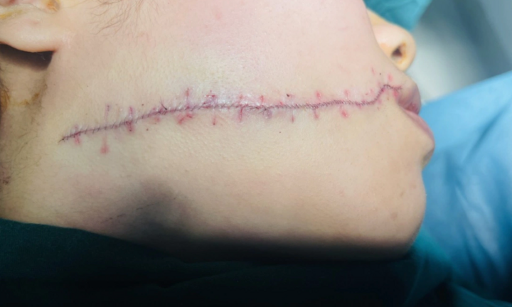 Bị bạn trai dùng dao rạch mặt trong lúc cãi vã