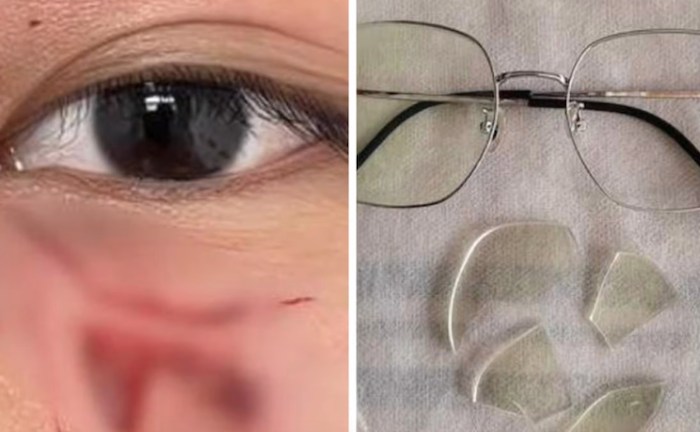 Không tập trung trong giờ học, một học sinh bị thầy giáo đấm vào mặt, phải khâu 16 mũi