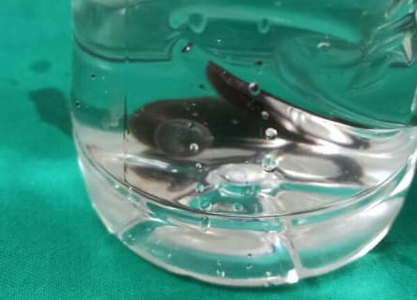 Nhập viện vì ho ra máu sau 2 tháng uống nước suối