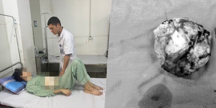 Kích hoạt báo động đỏ cứu thiếu niên ở Hà Nội có khối u gan nửa kg xâm lấn túi mật