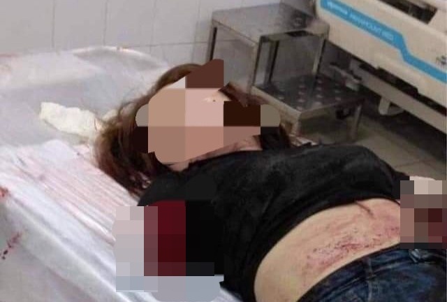 Điều tra vụ chồng dùng dao chém đứt 2 tay vợ, nghi vấn do ghen tuông