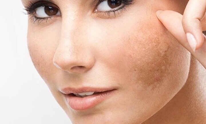 Da bị nhiễm chì gây nám do dùng kem trộn phải làm sao?