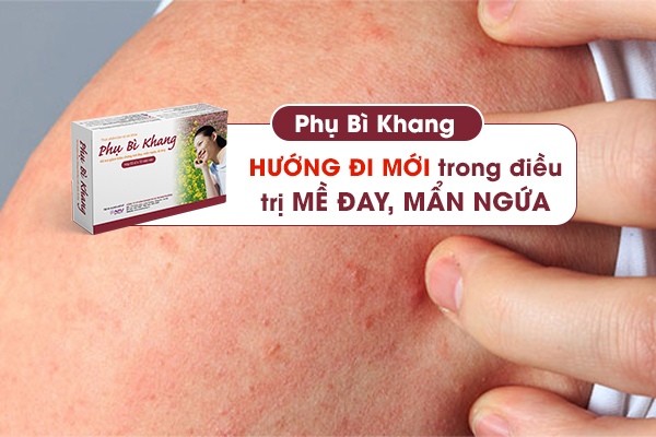 Phụ Bì Khang - Hướng đi mới trong điều trị mề đay, mẩn ngứa