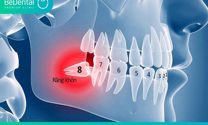 Nhổ răng khôn và răng cấm không đau tại Nha khoa thẩm mỹ Bedental
