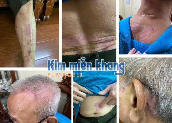Khổ sở vì bệnh vảy nến toàn thân, xem ngay bí quyết của cụ ông U70