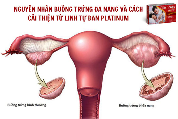 Nguyên nhân buồng trứng đa nang và cách cải thiện từ Linh Tự Đan Platinum