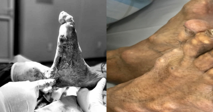 Tự ý dùng thuốc nam trị gout, cụ ông bị biến dạng chân