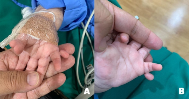 Phẫu thuật cho bé gái có 24 ngón tay, ngón chân do di truyền