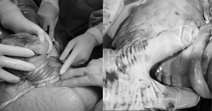 Bé sơ sinh chào đời bị dây rốn quấn 5 vòng quanh cổ được cấp cứu kịp thời