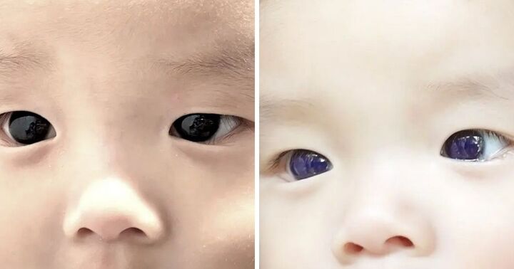 Kinh ngạc đôi mắt bé sơ sinh chuyển màu xanh sau khi dùng thuốc điều trị COVID-19