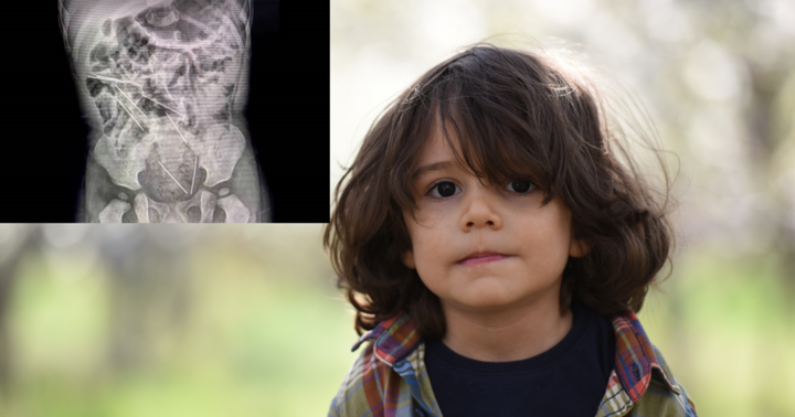 Bé trai tại Peru nuốt 8 kim tiêm khi chơi đùa tại trang trại