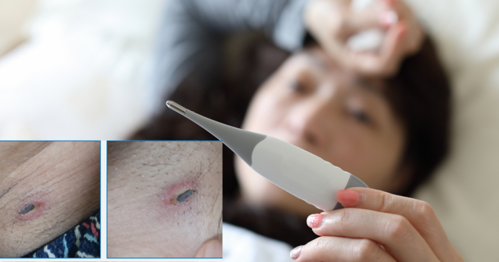 Sốt liên tục nhiều ngày không đỡ, nhập viện phát hiện mắc sốt mò