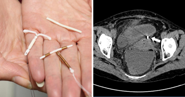 Bệnh nhân gần 70 tuổi thủng tử cung vì vòng tránh thai đặt cách đây 30 năm