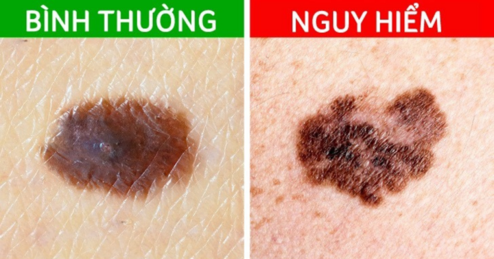 Cẩn thận với nốt ruồi