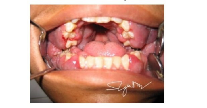 Đột ngột lợi sưng to, nam sinh 16 tuổi phát hiện ung thư máu