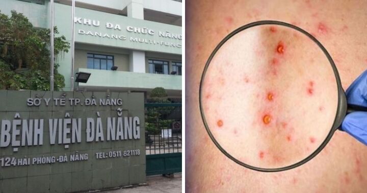 Đà Nẵng: Thực hiện cách ly ca nghi mắc bệnh đầu mùa khỉ 