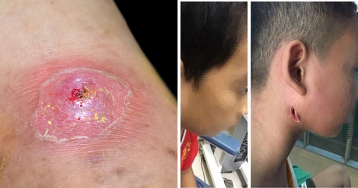 Nữ bệnh nhân ở Quảng Nam tử vong vì vi khuẩn 