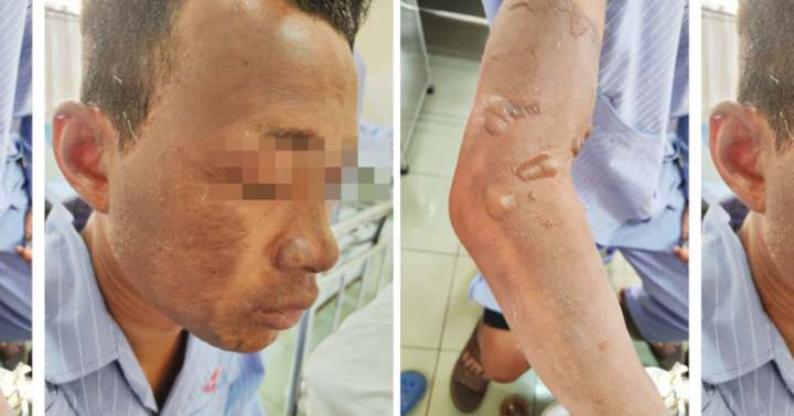 Dùng xăng đốt rác, người đàn ông bị bỏng nặng vì lửa bùng vào người