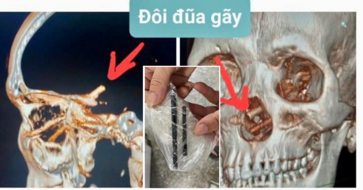 Bị bạn nhậu dùng đũa đâm xuyên mũi, 5 tháng sau mới phát hiện
