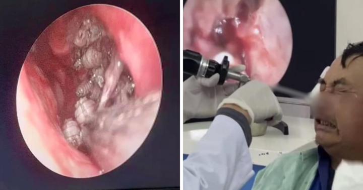 Kinh hãi cảnh người đàn ông bị hơn 100 con giòi làm tổ trong hốc mũi