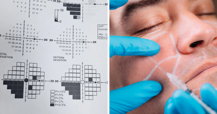 Tiêm filler vào vùng trán lõm, nam thanh niên 23 tuổi có nguy cơ mù lòa