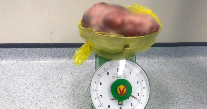 Thiếu nữ 15 tuổi mang khối u ác tính nặng bằng thai 